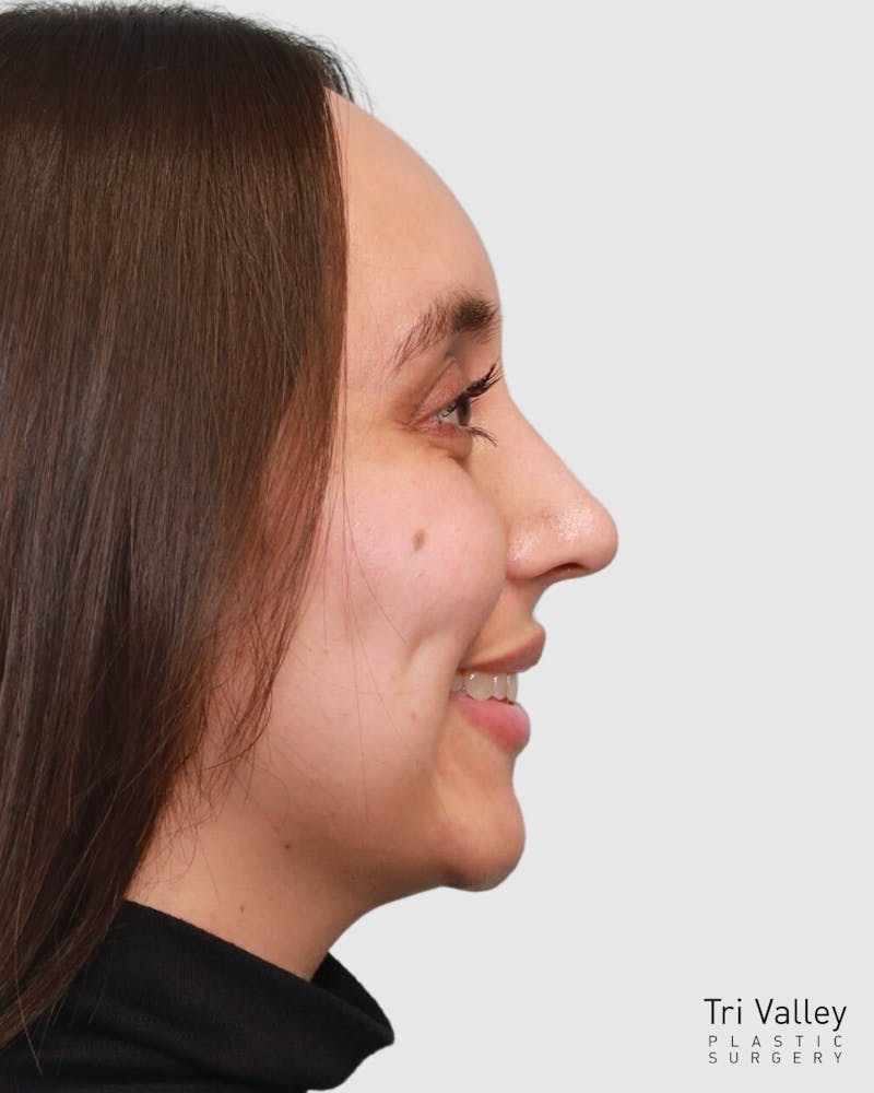 Rhinoplasty Before & After Gallery - Patient 204021 - Image 2