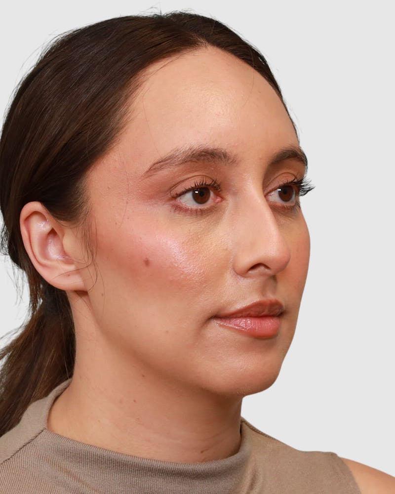 Rhinoplasty Before & After Gallery - Patient 204021 - Image 3