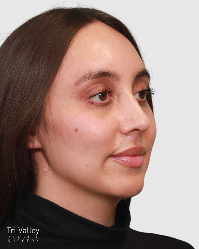 Rhinoplasty Before & After Gallery - Patient 204021 - Image 4