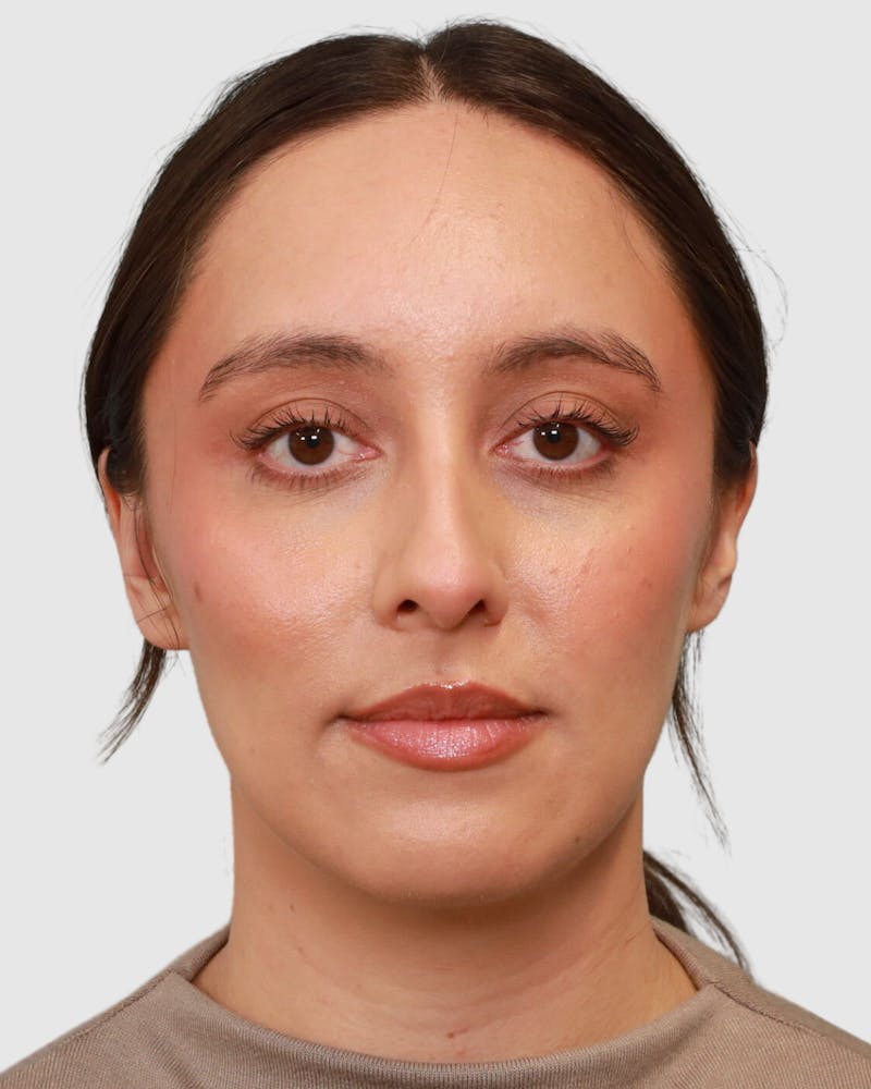 Rhinoplasty Before & After Gallery - Patient 204021 - Image 5