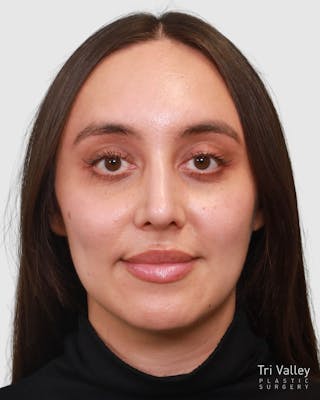 Rhinoplasty Before & After Gallery - Patient 204021 - Image 6