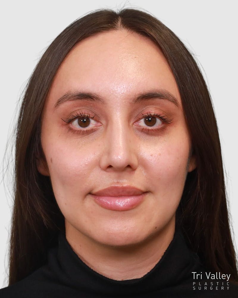 Rhinoplasty Before & After Gallery - Patient 204021 - Image 6