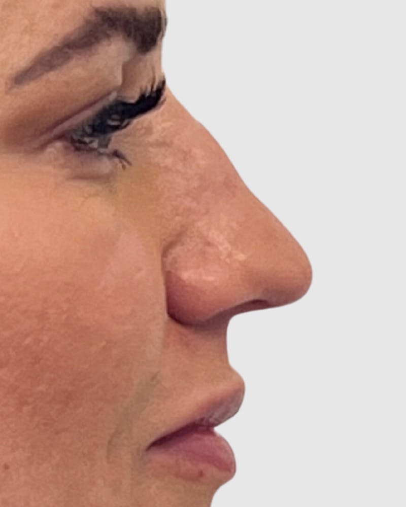 Rhinoplasty Before & After Gallery - Patient 222207 - Image 1