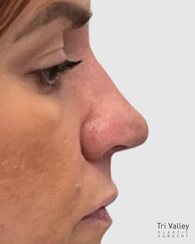 Rhinoplasty Before & After Gallery - Patient 222207 - Image 2