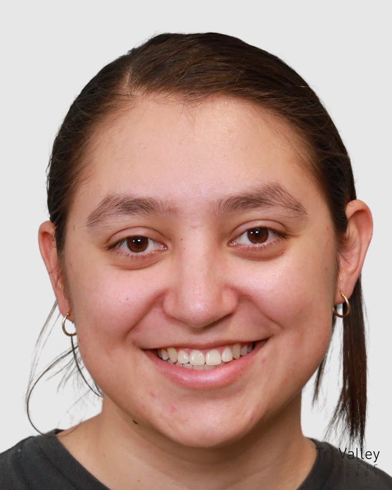 Rhinoplasty Before & After Gallery - Patient 297690 - Image 2