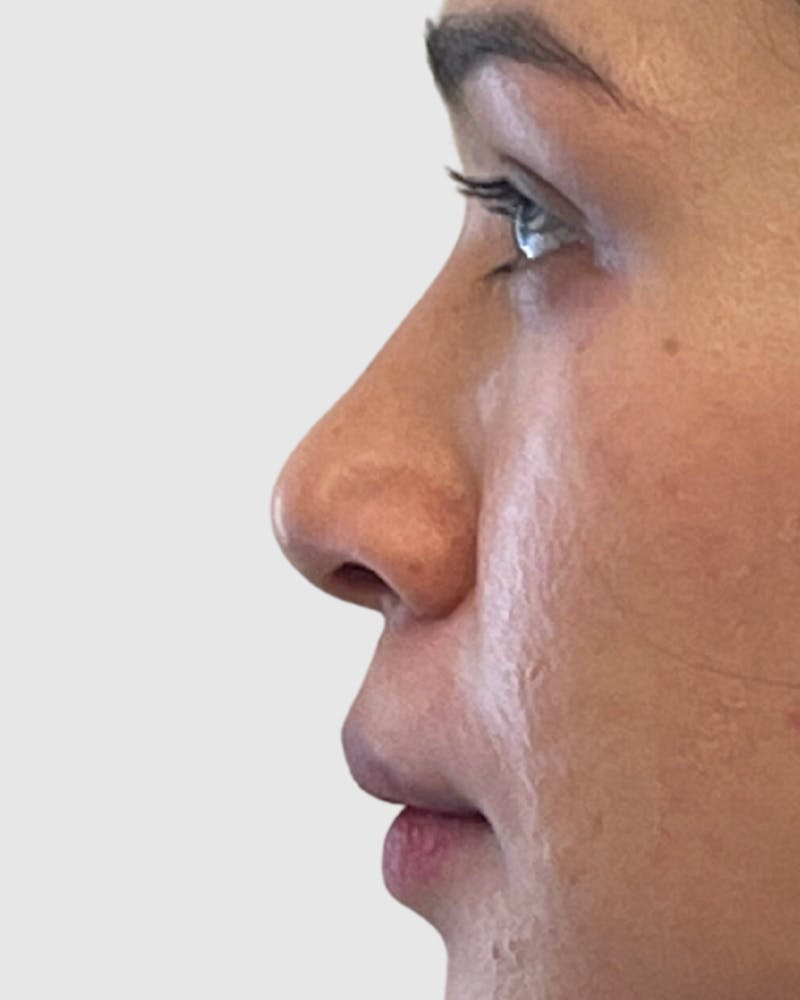 Rhinoplasty Before & After Gallery - Patient 278269 - Image 1