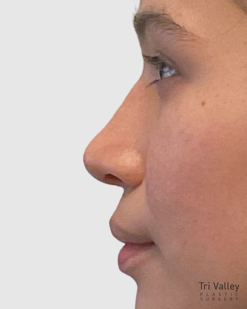 Rhinoplasty Before & After Gallery - Patient 278269 - Image 2