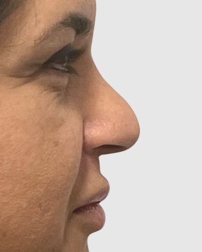 Rhinoplasty Before & After Gallery - Patient 410399 - Image 1
