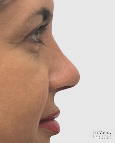 Rhinoplasty Before & After Gallery - Patient 410399 - Image 2