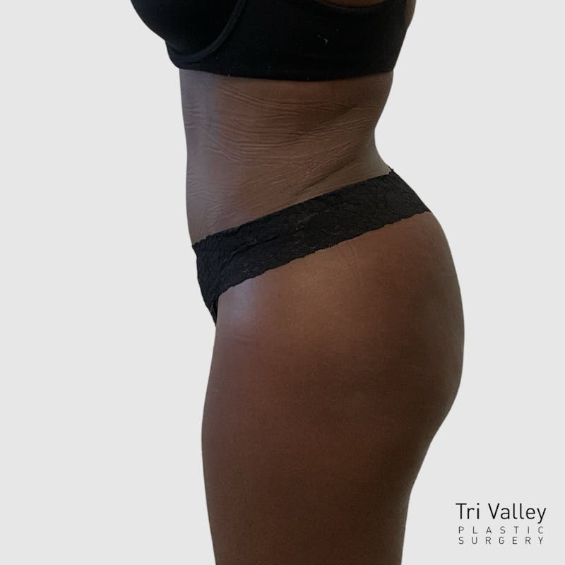 Tummy Tuck Before & After Gallery - Patient 355045 - Image 6