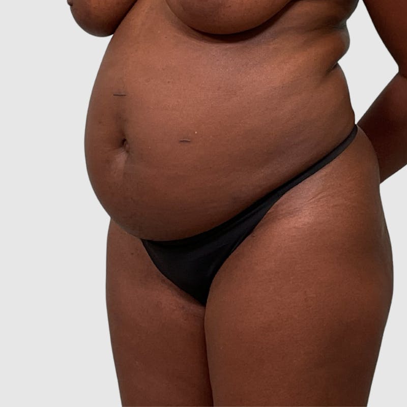 Tummy Tuck Before & After Gallery - Patient 355045 - Image 3