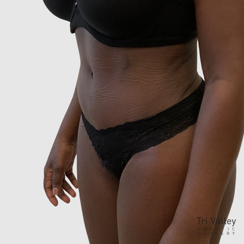 Tummy Tuck Before & After Gallery - Patient 355045 - Image 4