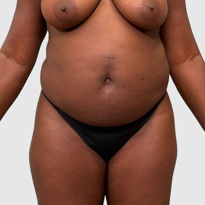 Tummy Tuck Before & After Gallery - Patient 355045 - Image 1