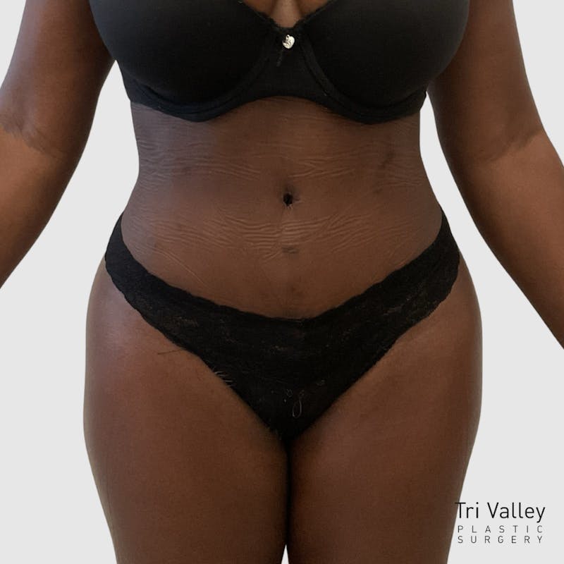 Tummy Tuck Before & After Gallery - Patient 355045 - Image 2