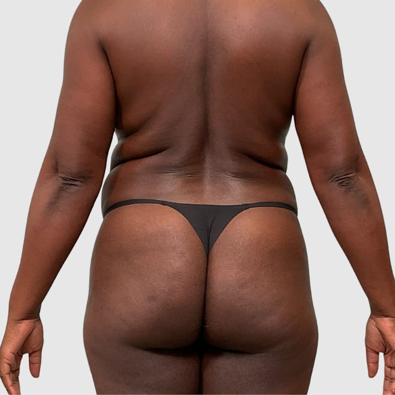 Tummy Tuck Before & After Gallery - Patient 355045 - Image 7