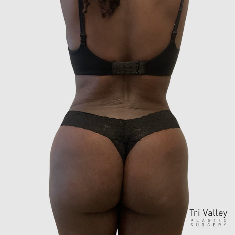 Tummy Tuck Before & After Gallery - Patient 355045 - Image 8