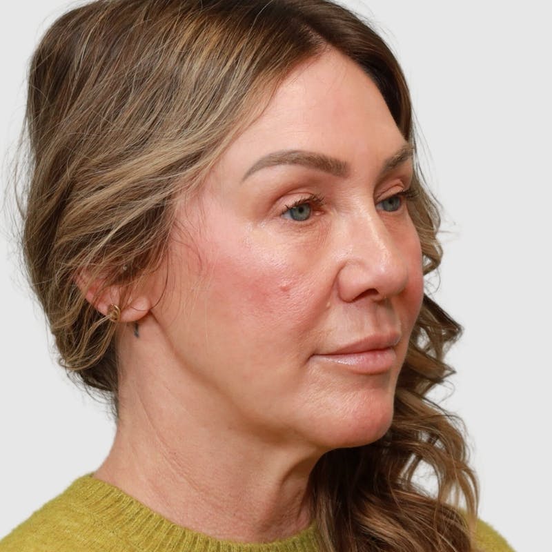 Face and Neck Lifts Before & After Gallery - Patient 190169 - Image 1