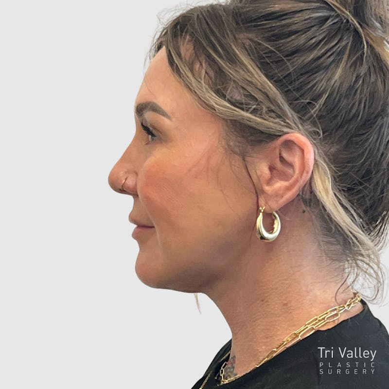 Face and Neck Lifts Before & After Gallery - Patient 190169 - Image 10