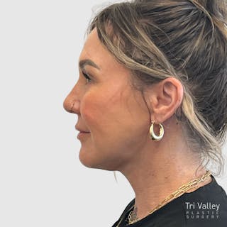 Face and Neck Lifts Before & After Gallery - Patient 190169 - Image 10