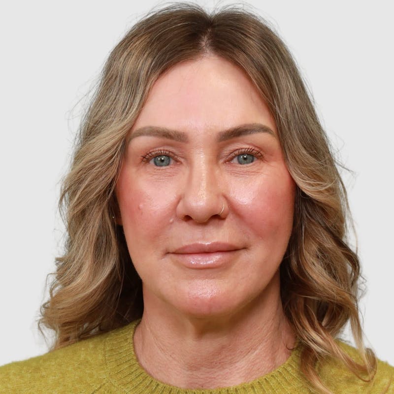 Face and Neck Lifts Before & After Gallery - Patient 190169 - Image 7