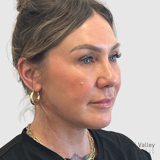 Face and Neck Lifts Before & After Gallery - Patient 190169 - Image 2