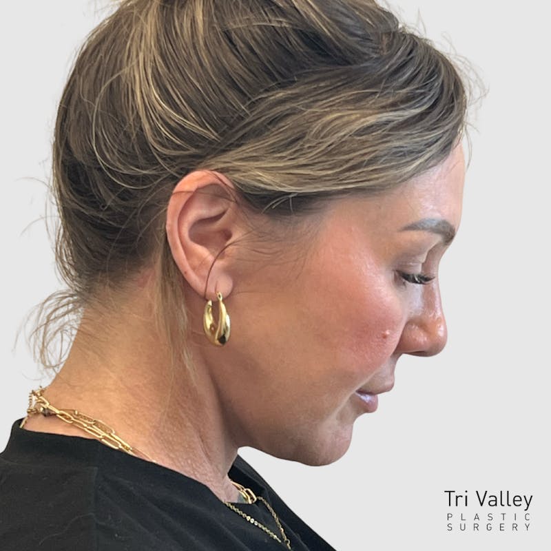 Face and Neck Lifts Before & After Gallery - Patient 190169 - Image 6