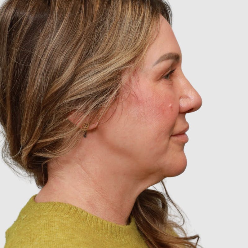 Face and Neck Lifts Before & After Gallery - Patient 190169 - Image 3