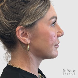 Face and Neck Lifts Before & After Gallery - Patient 190169 - Image 4