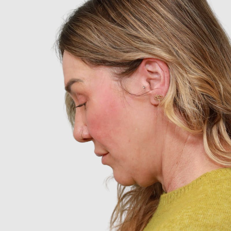 Face and Neck Lifts Before & After Gallery - Patient 190169 - Image 11