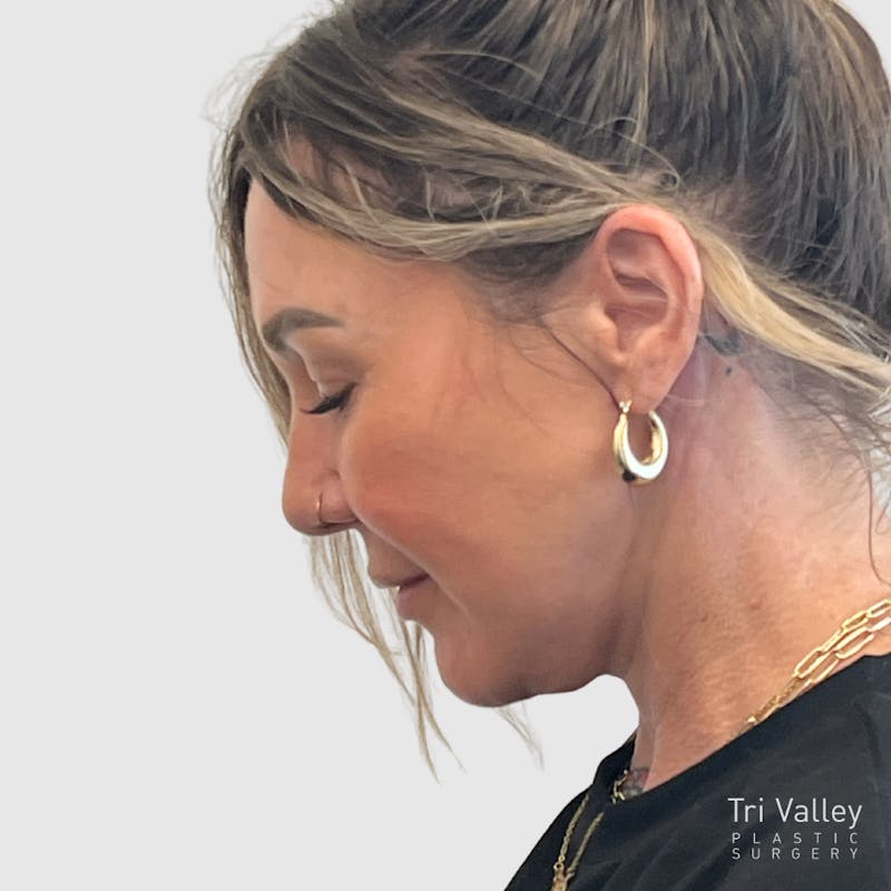 Face and Neck Lifts Before & After Gallery - Patient 190169 - Image 12