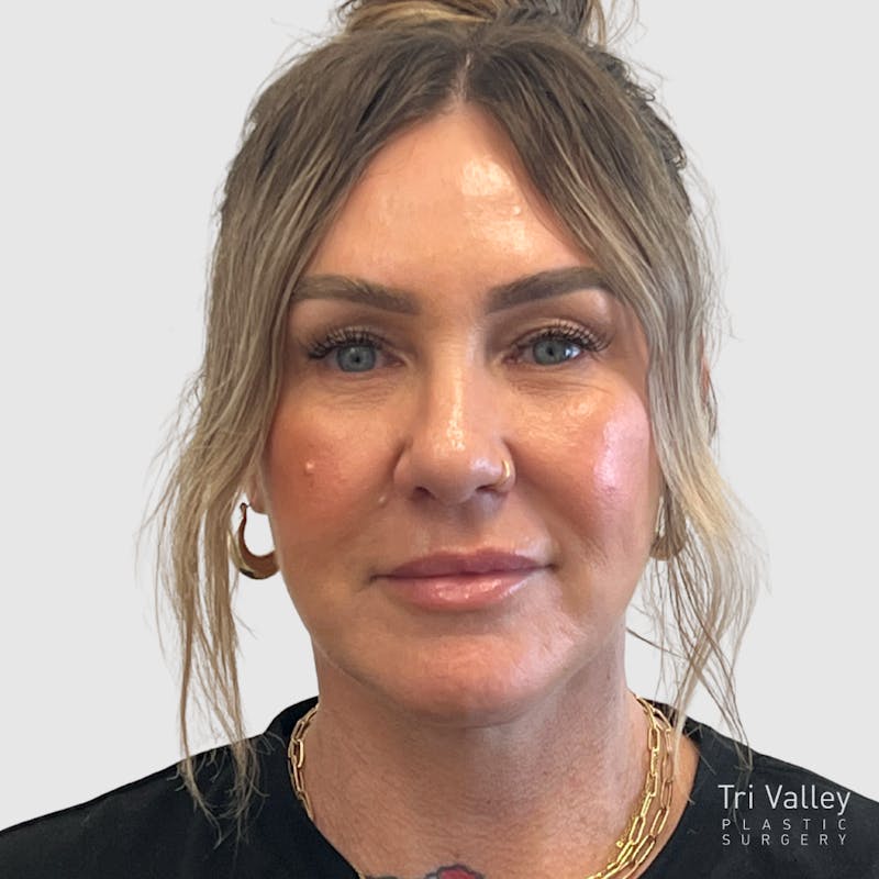 Face and Neck Lifts Before & After Gallery - Patient 190169 - Image 8