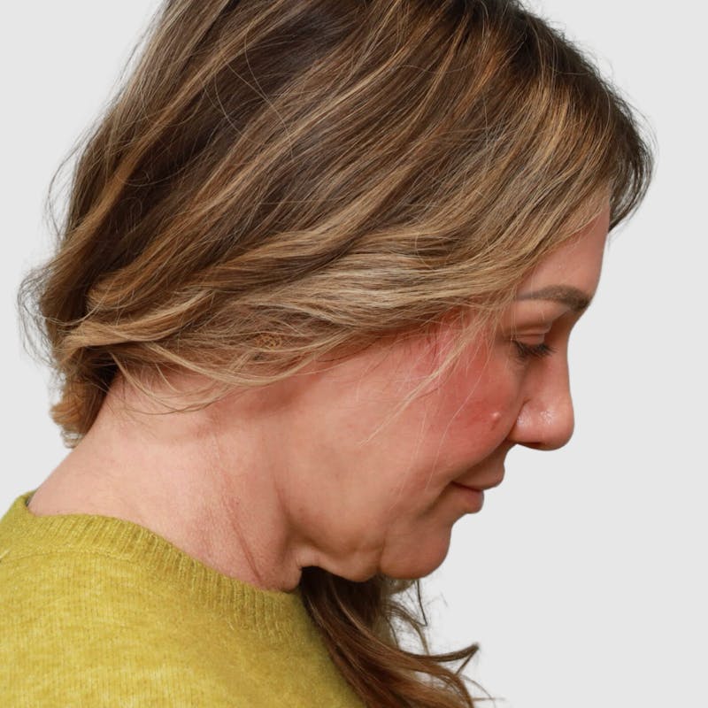 Face and Neck Lifts Before & After Gallery - Patient 190169 - Image 5