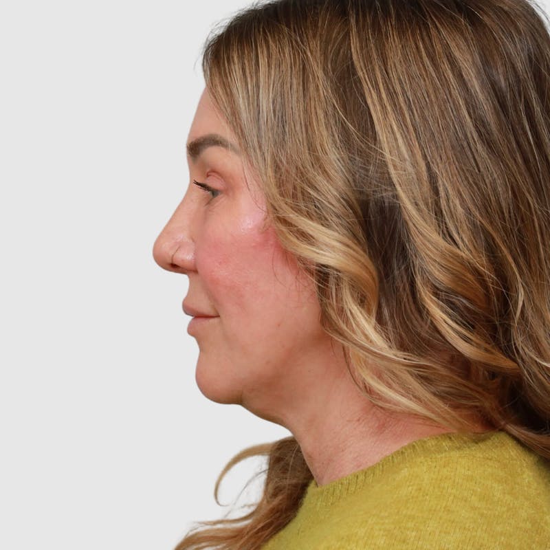 Face and Neck Lifts Before & After Gallery - Patient 190169 - Image 9