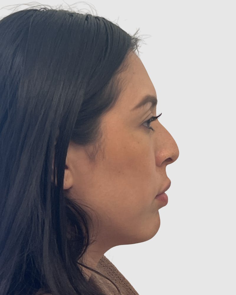 Rhinoplasty Before & After Gallery - Patient 141222 - Image 1