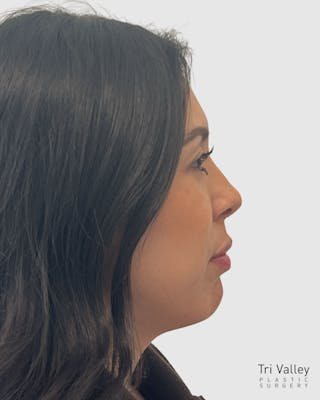 Rhinoplasty Before & After Gallery - Patient 141222 - Image 2