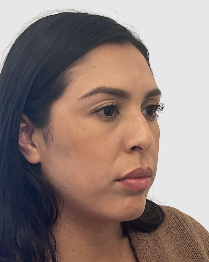 Rhinoplasty Before & After Gallery - Patient 141222 - Image 3