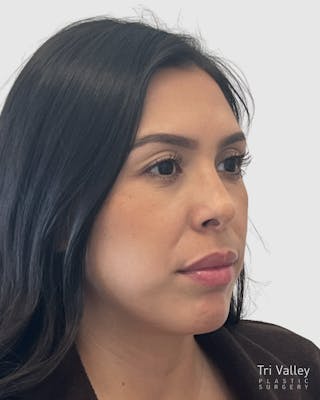 Rhinoplasty Before & After Gallery - Patient 141222 - Image 4