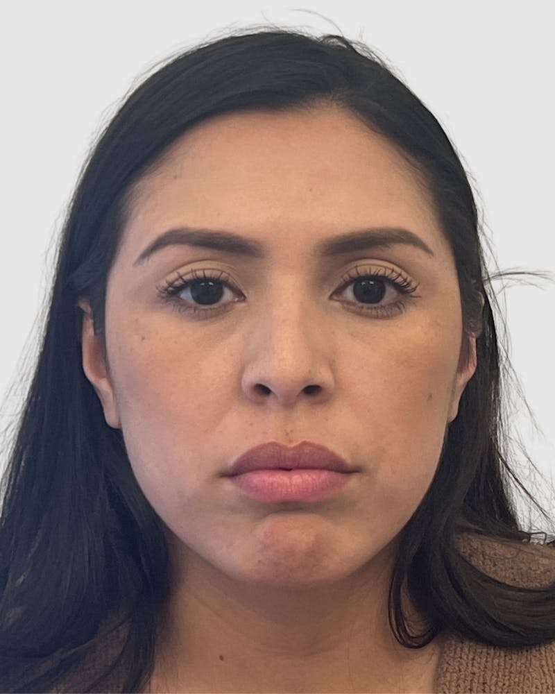 Rhinoplasty Before & After Gallery - Patient 141222 - Image 5