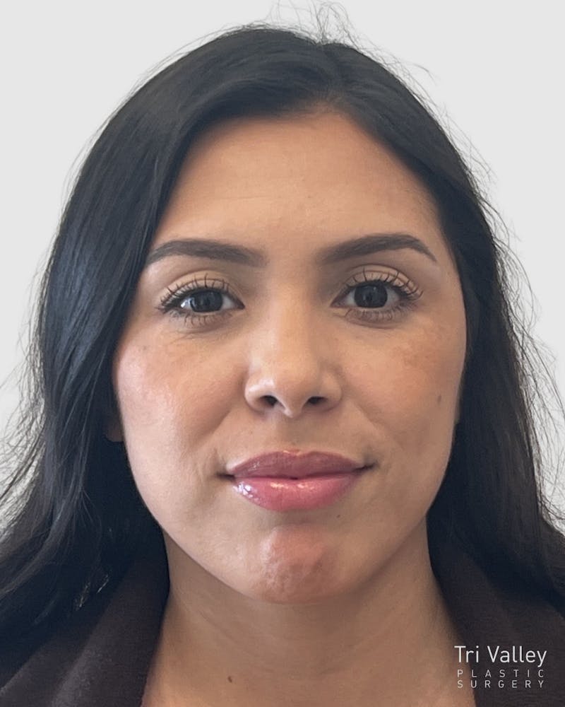 Rhinoplasty Before & After Gallery - Patient 141222 - Image 6