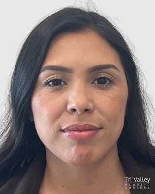 Rhinoplasty Before & After Gallery - Patient 141222 - Image 6