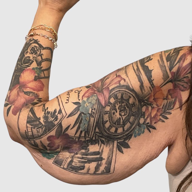 Brachioplasty Before & After Gallery - Patient 293305 - Image 3