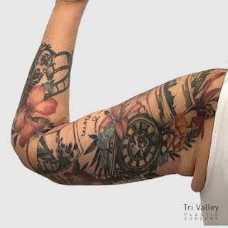 Brachioplasty Before & After Gallery - Patient 293305 - Image 4