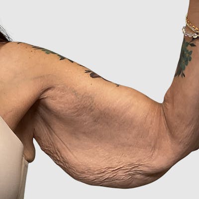 Brachioplasty Before & After Gallery - Patient 293305 - Image 1