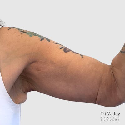 Brachioplasty Before & After Gallery - Patient 293305 - Image 2