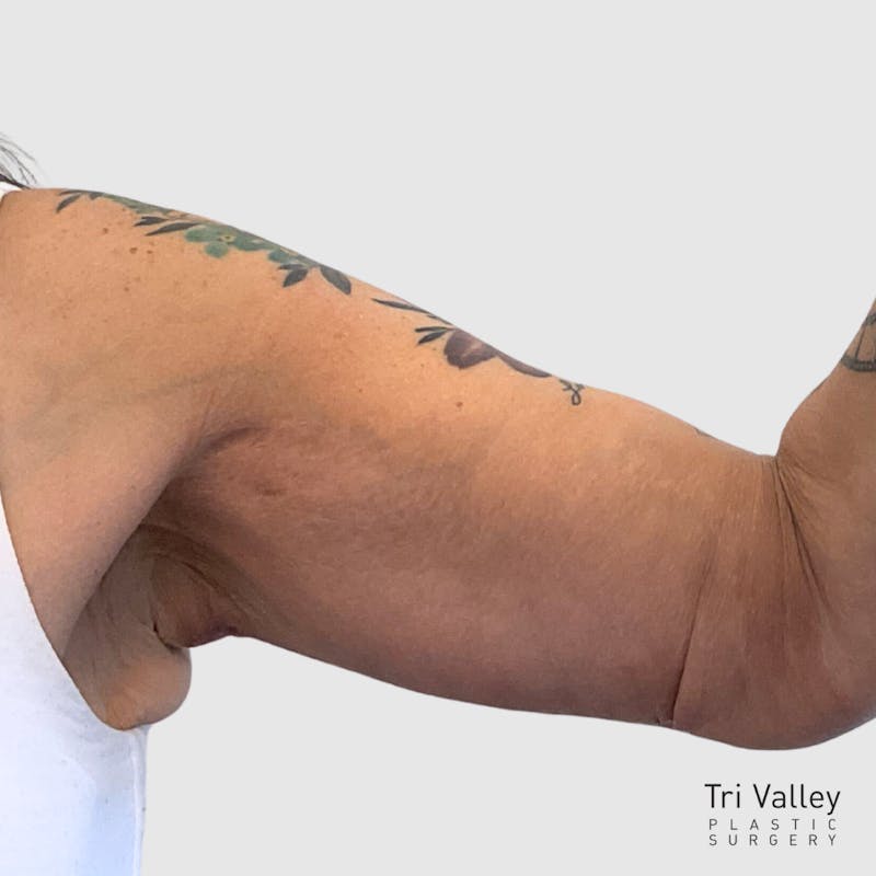 Brachioplasty Before & After Gallery - Patient 293305 - Image 2