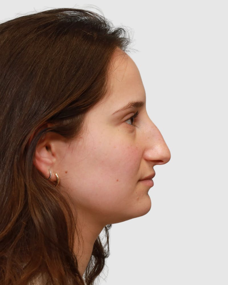 Rhinoplasty Before & After Gallery - Patient 182401 - Image 1