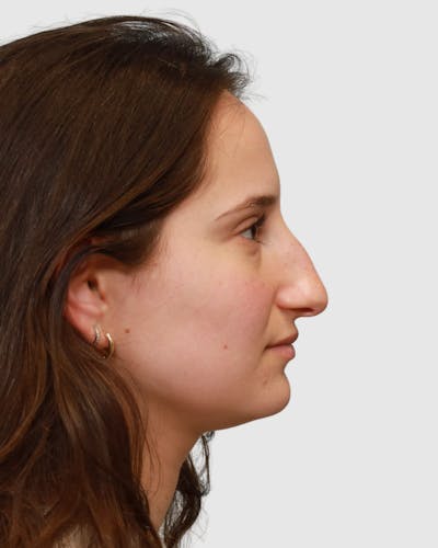 Rhinoplasty Before & After Gallery - Patient 182401 - Image 1