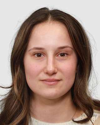 Rhinoplasty Before & After Gallery - Patient 182401 - Image 4