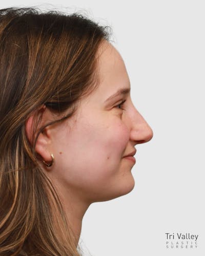 Rhinoplasty Before & After Gallery - Patient 182401 - Image 2