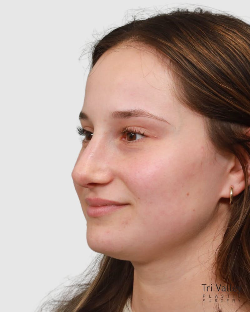 Rhinoplasty Before & After Gallery - Patient 182401 - Image 8